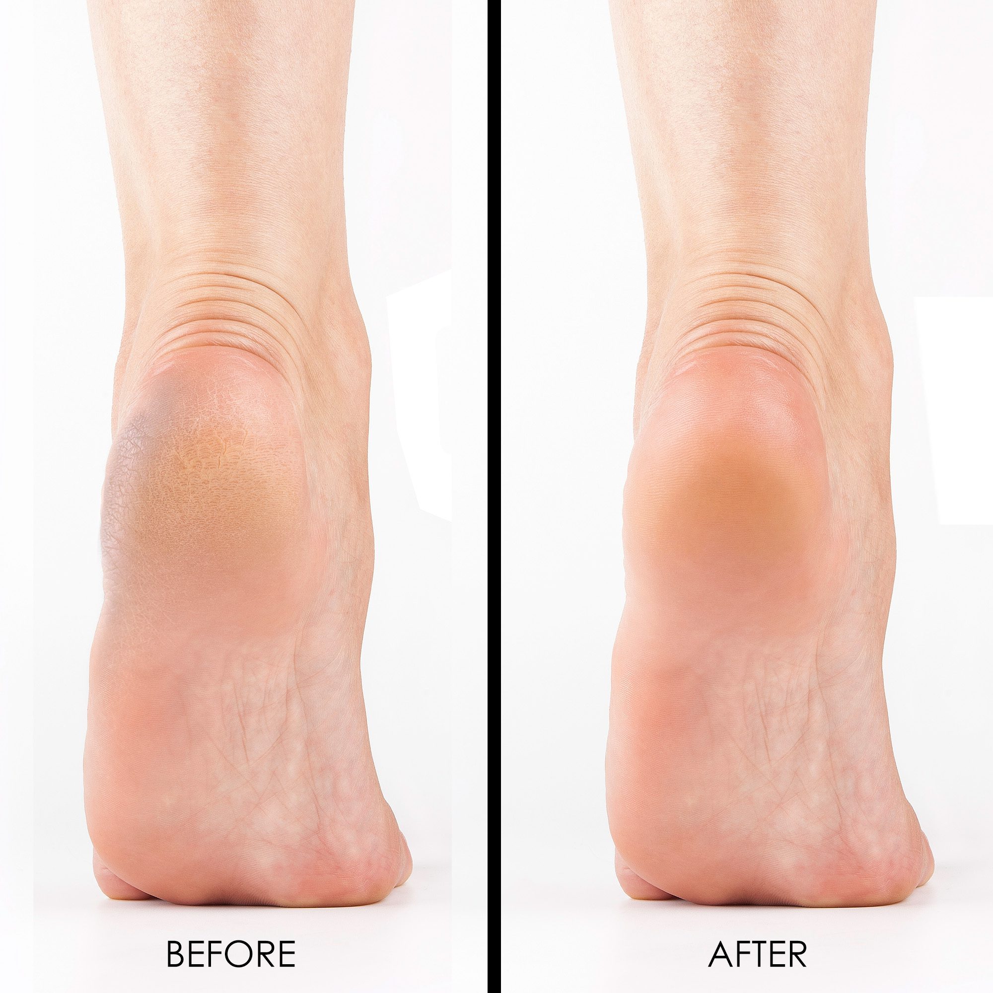 Dr Foot Callus Remover Gel Helps to remove Calluses and Corns 100ml
